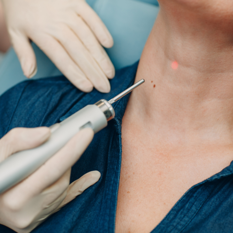 scar treatment