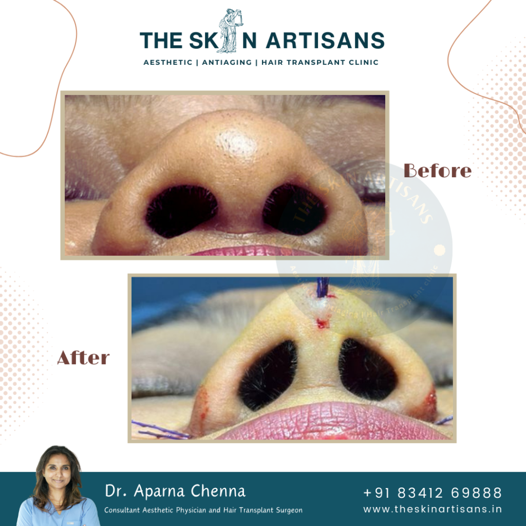 Rhinoplasty